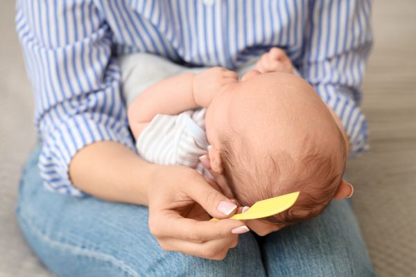 Cradle cap treatment for newborns